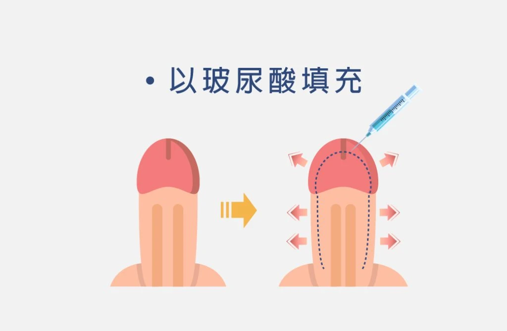 玻尿酸注射示意圖