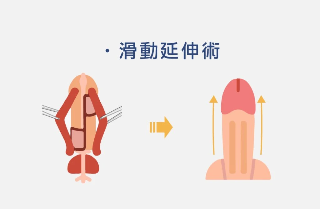 滑動延伸術示意圖