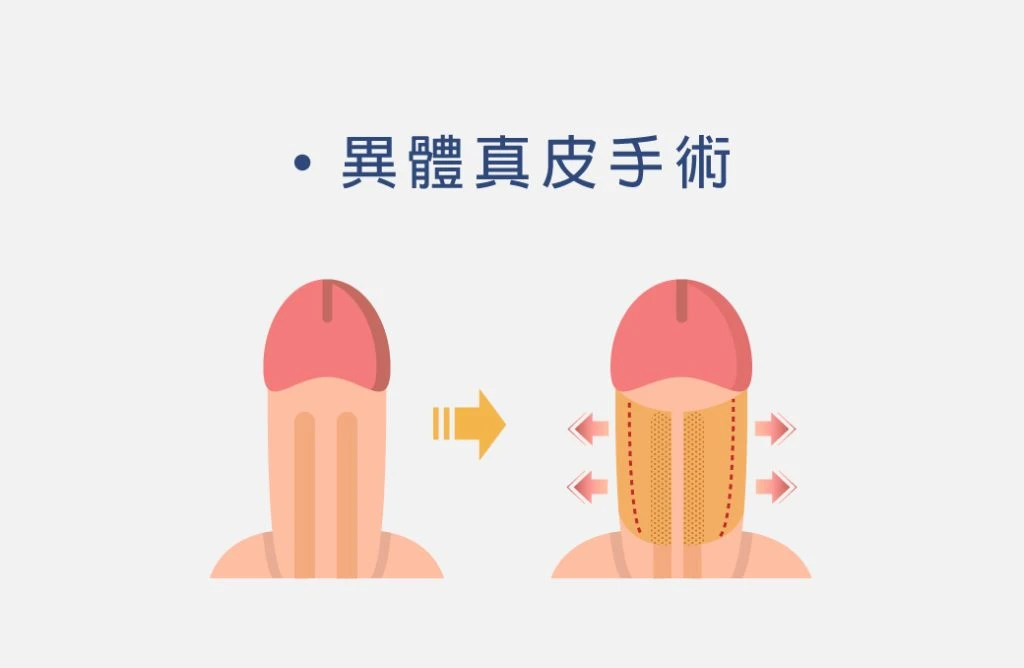 異體真皮手術示意圖