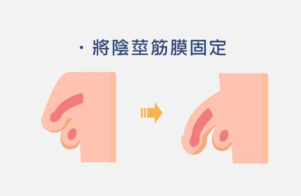 陰莖筋膜固定手術示意圖