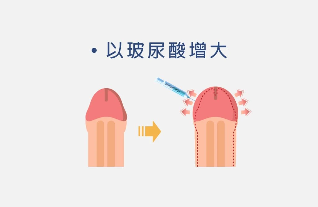 玻尿酸龜頭增大示意圖