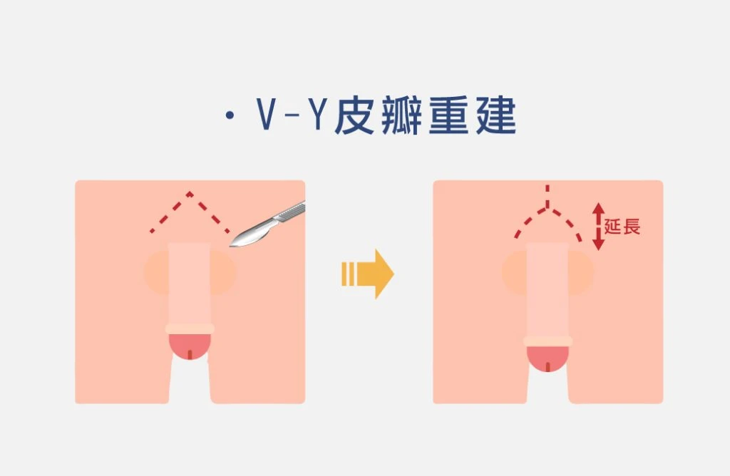 V-Y皮瓣重建手術示意圖