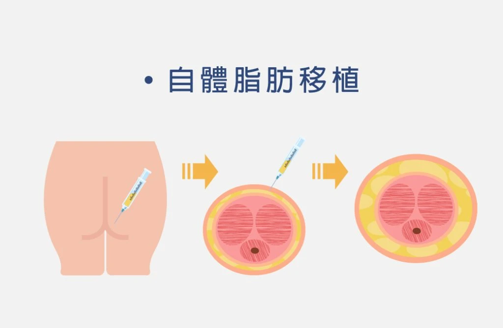 自體脂肪移植手術示意圖