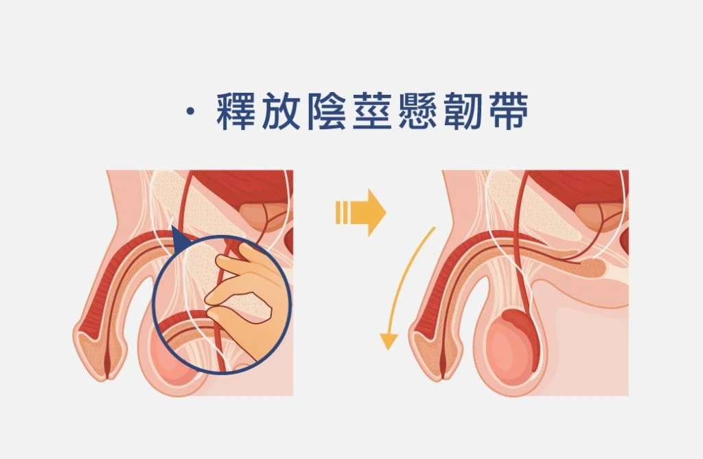 釋放陰莖懸韌帶手術示意圖