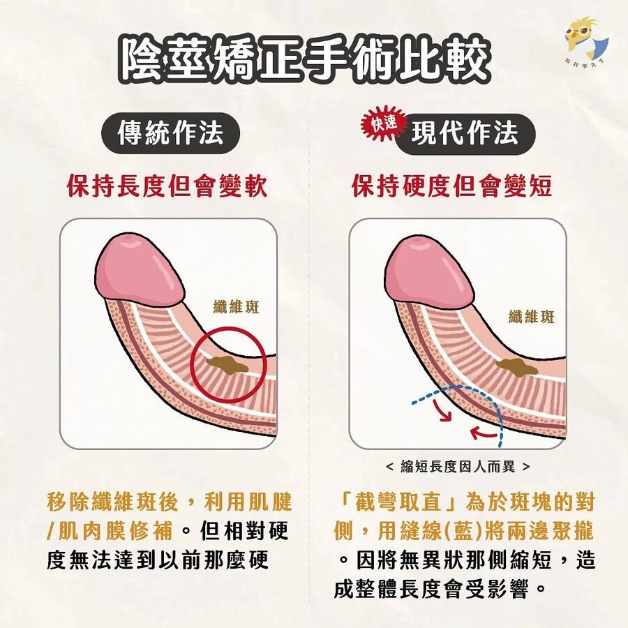 陰莖矯正手術示意圖
