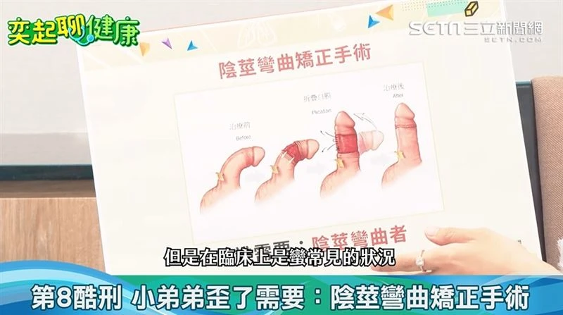 陰莖彎曲矯正與硬結治療示意圖